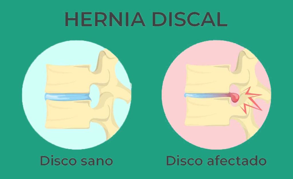 herniated disk