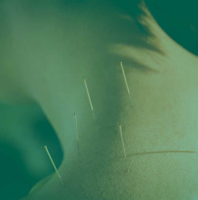 cannabis acupuntura