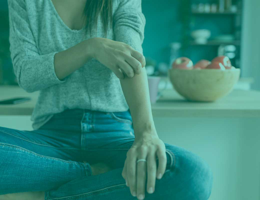 cbd pour le soulagement du psoriasis