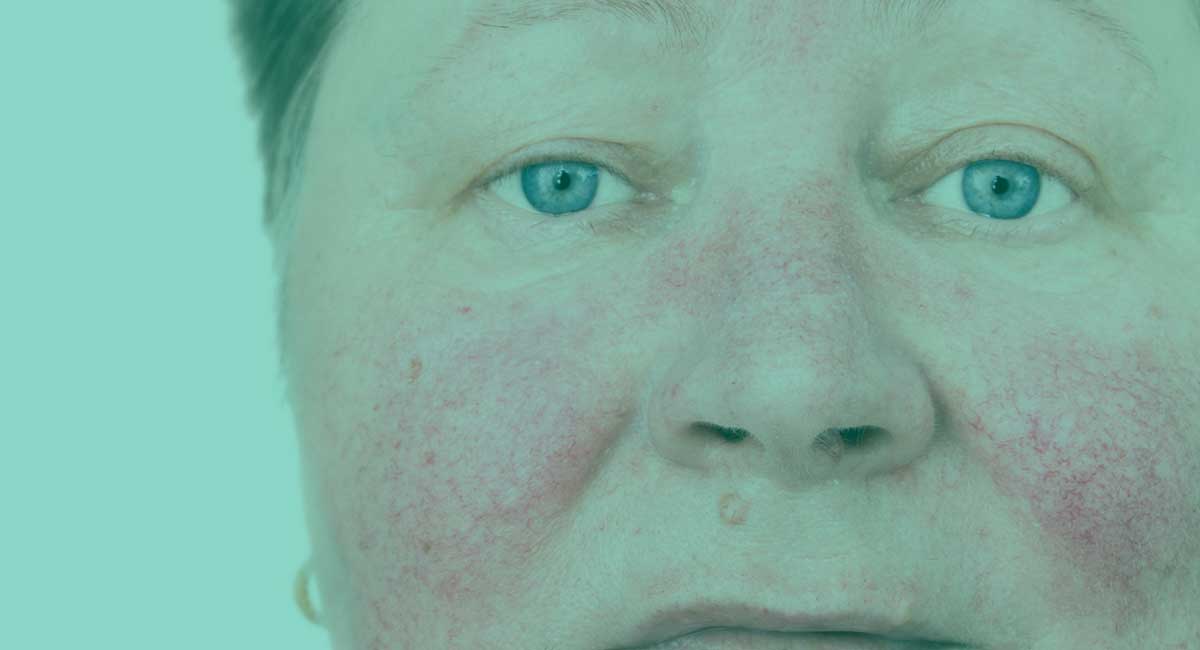 cbd rosacea